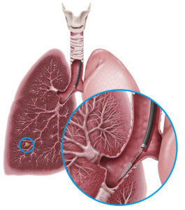 Scientific illustration of lungs with a close up of a bronchoscopy brushing lung tissue.