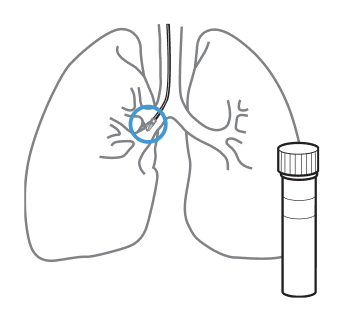 Graphical representation of a transbronchial lung biopsy, showing the brushing location in the lung and a collection tube in the foreground.