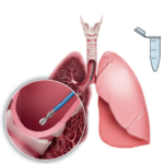 Scientific illustration of lungs with a close-up of a bronchoscopy brushing lung tissue and a test tube